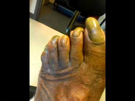 ugly feet pics|Ugly Feet Pictures 